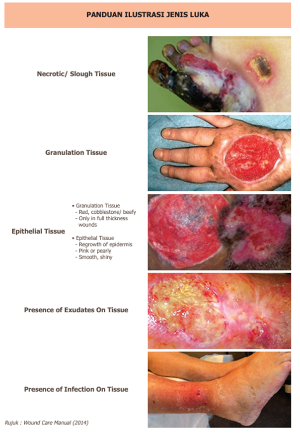 Jenis luka